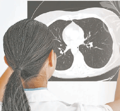 Woodlands Lung Cancer Screening Pensacola